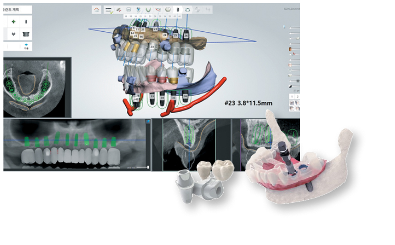 3D 디지털 분석 임플란트